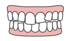 叢生(乱ぐい歯)のイラスト