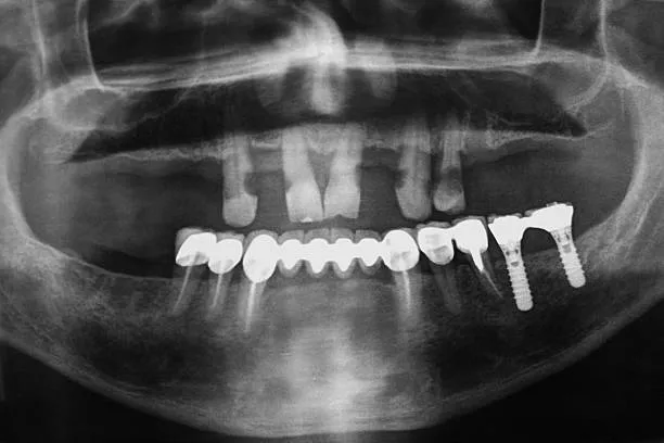 x-ray image of human jaw with implanted teeth.