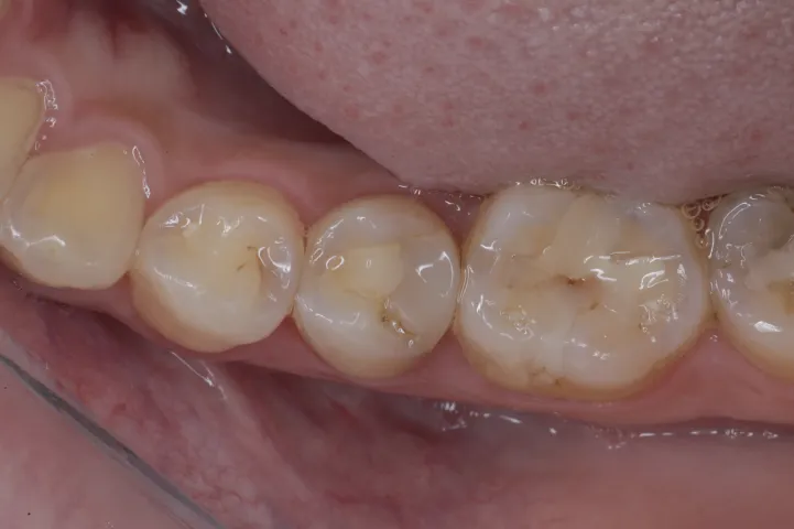 セラミック治療（e-max CAD)症例Before