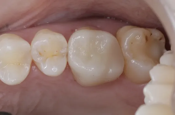 セラミック治療（e-max CAD)症例After