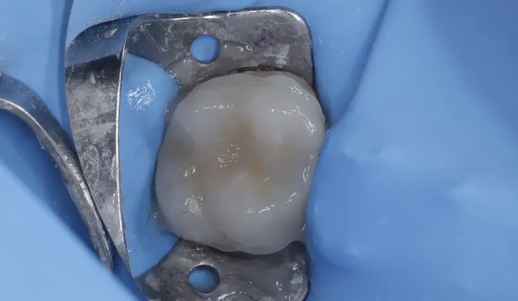 セラミック治療（e-max CAD)After