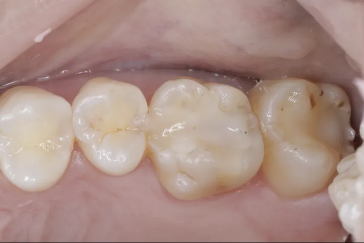 セラミック治療（e-max CAD)症例Before