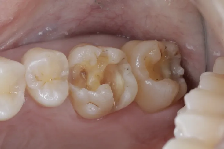セラミック治療（e-max CAD)症例Before