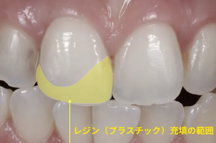 レジン（プラスチック）充填の範囲