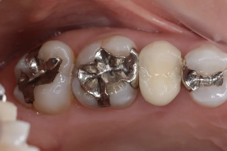 セラミック治療（e-max CAD)Before